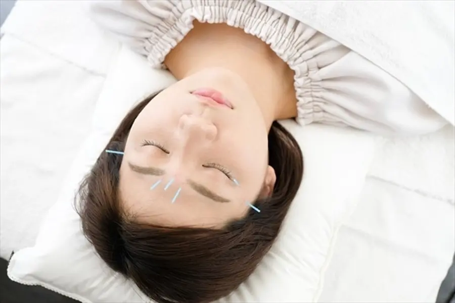 【大阪府池田市石橋の鍼灸院はりとおきゅうとエム】顔に数本鍼を刺している美容鍼のイメージ画像