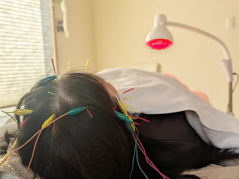 【大阪府池田市石橋の鍼灸院はりとおきゅうとエム】の薄毛鍼灸治療中の頭皮に鍼を刺し、電気を流している育毛・薄毛鍼灸プレミアムコースの施術風景