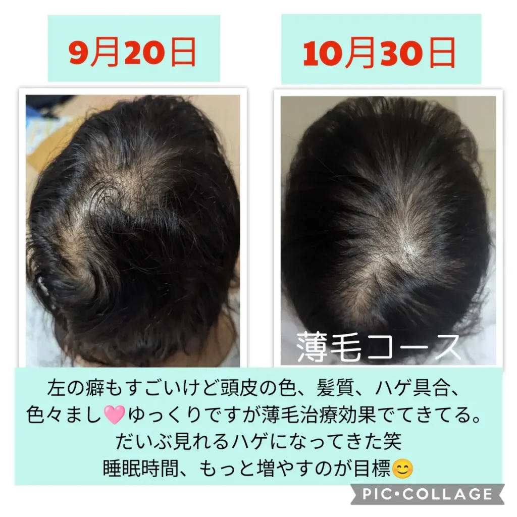 【大阪府池田市石橋の鍼灸院はりとおきゅうとエム】の院長田中の薄毛鍼灸治療による頭髪の変化