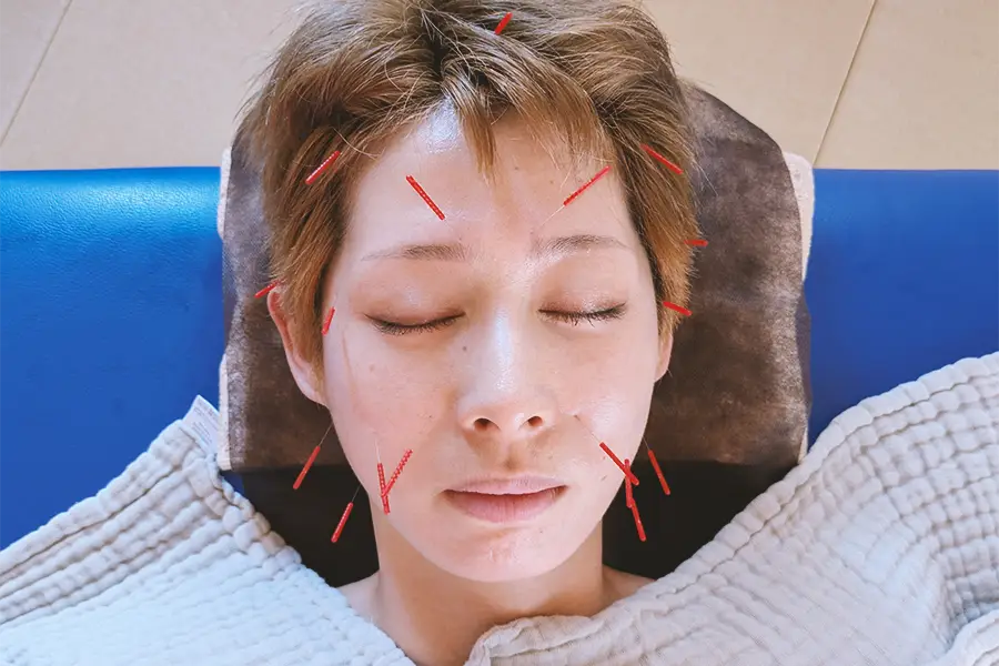 【大阪府池田市石橋の鍼灸院はりとおきゅうとエム】美容鍼のオプション施術