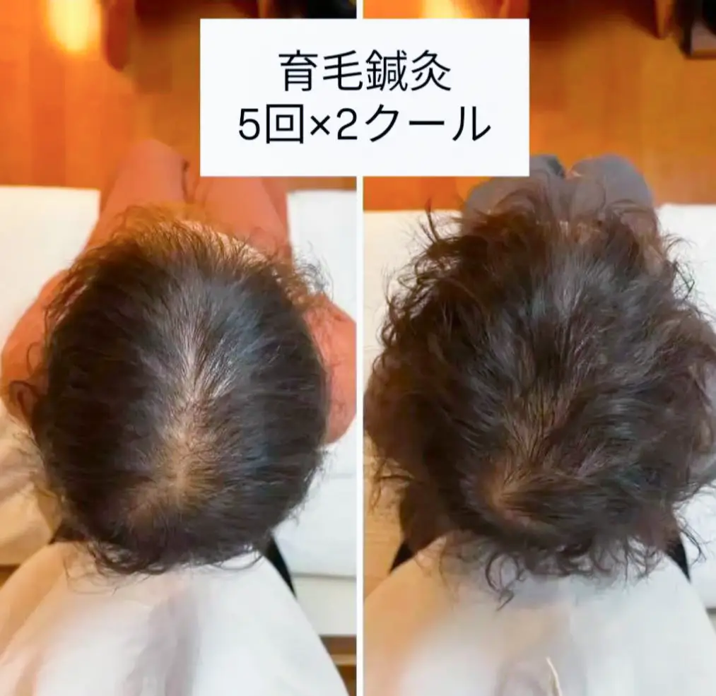 育毛鍼灸を5回×2クール受けた方の頭頂部の変化(施術前と施術後)